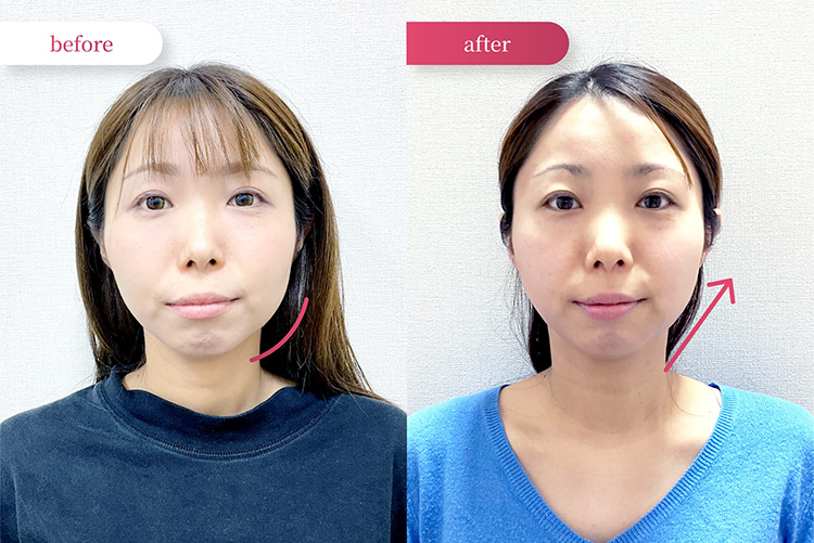 ビフォーアフター
